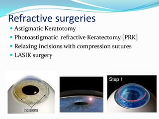 Refractive surgeries
 Astigmatic Keratotomy
 Photoastigmatic refractive Keratectomy [PRK]
 Relaxing incisions with compression sutures
 LASIK surgery
 