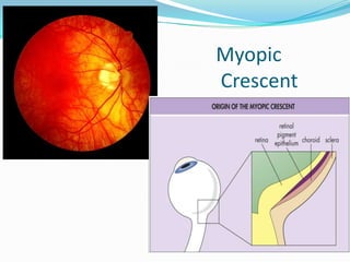 Myopic
Crescent
 