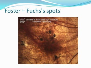 Foster – Fuchs's spots
 