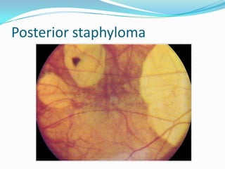 Posterior staphyloma
 