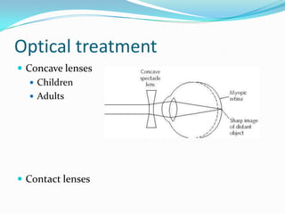 Optical treatment
 Concave lenses
 Children
 Adults
 Contact lenses
 