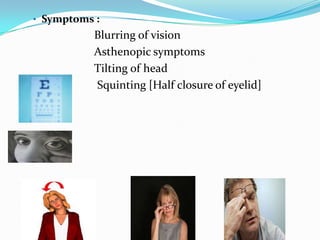 • Symptoms :
Blurring of vision
Asthenopic symptoms
Tilting of head
Squinting [Half closure of eyelid]
 