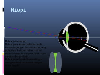 Miopi
Rabun jauh (miopi)
Rabun jauh adalah kelainan mata
karena bayangan benda-benda yang
jauh jatuh di depan retina. Hal ini
terjadi karena lensa mata tidak dapat
menipis dengan baik.
Rabun jauh dapat dibantu dengan
menggunakan kaca mata dengan
lensa negatif.
 