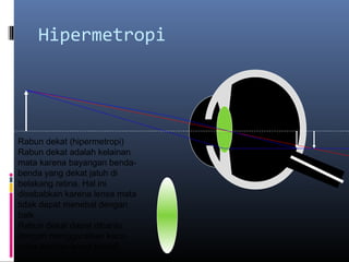 Hipermetropi
Rabun dekat (hipermetropi)
Rabun dekat adalah kelainan
mata karena bayangan benda-
benda yang dekat jatuh di
belakang retina. Hal ini
disebabkan karena lensa mata
tidak dapat menebal dengan
baik.
Rabun dekat dapat dibantu
dengan menggunakan kaca
mata dengan lensa positif.
 