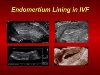 Optimal endometrial preparation for frozen embryo transfer cycles 