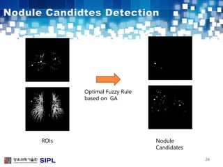 24 
Optimal Fuzzy Rule 
based on GA 
ROIs Nodule 
Candidates 
 