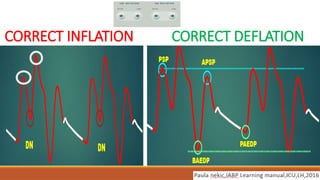 Optimisation of Intraaortic balloon pumping-IABP.ppt