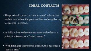 OPTIMISING TOOTH FORM WITH DIRECT POSTERIOR COMPOSITE RESTORATION.pptx