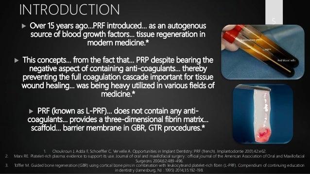 Optimized Platelet Rich Fibrin With The Low Speed Concept - 