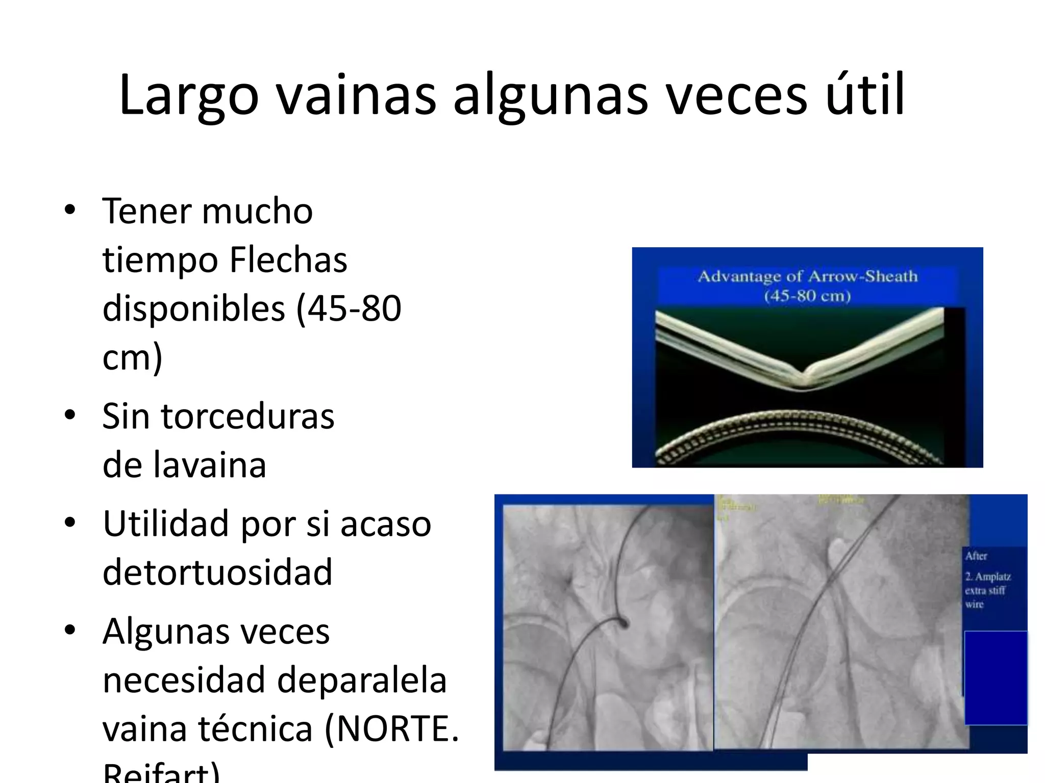 • Tener mucho
tiempo Flechas
disponibles (45-80
cm)
• Sin torceduras
de lavaina
• Utilidad por si acaso
detortuosidad
• Algunas veces
necesidad deparalela
vaina técnica (NORTE.
Largo vainas algunas veces útil
 