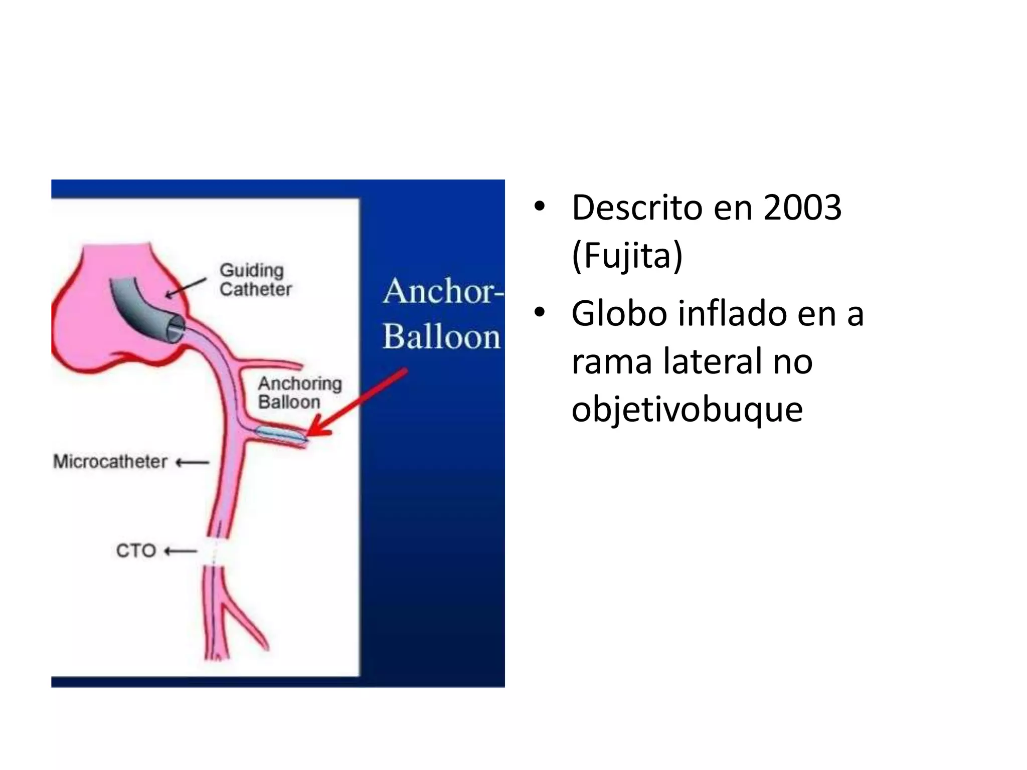 • Descrito en 2003
(Fujita)
• Globo inflado en a
rama lateral no
objetivobuque
 