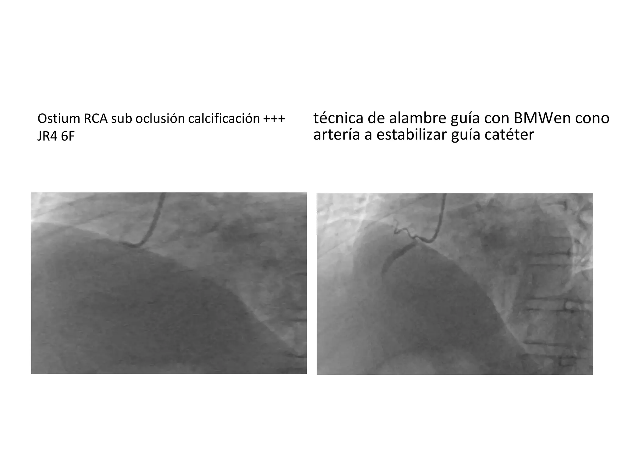 Ostium RCA sub oclusión calcificación +++
JR4 6F
técnica de alambre guía con BMWen cono
artería a estabilizar guía catéter
 