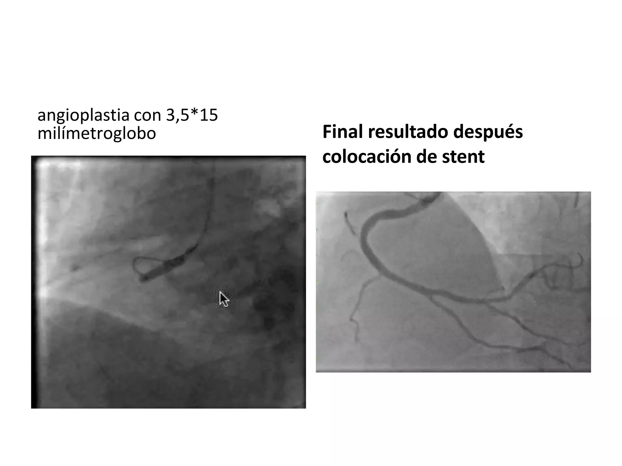 angioplastia con 3,5*15
milímetroglobo Final resultado después
colocación de stent
 