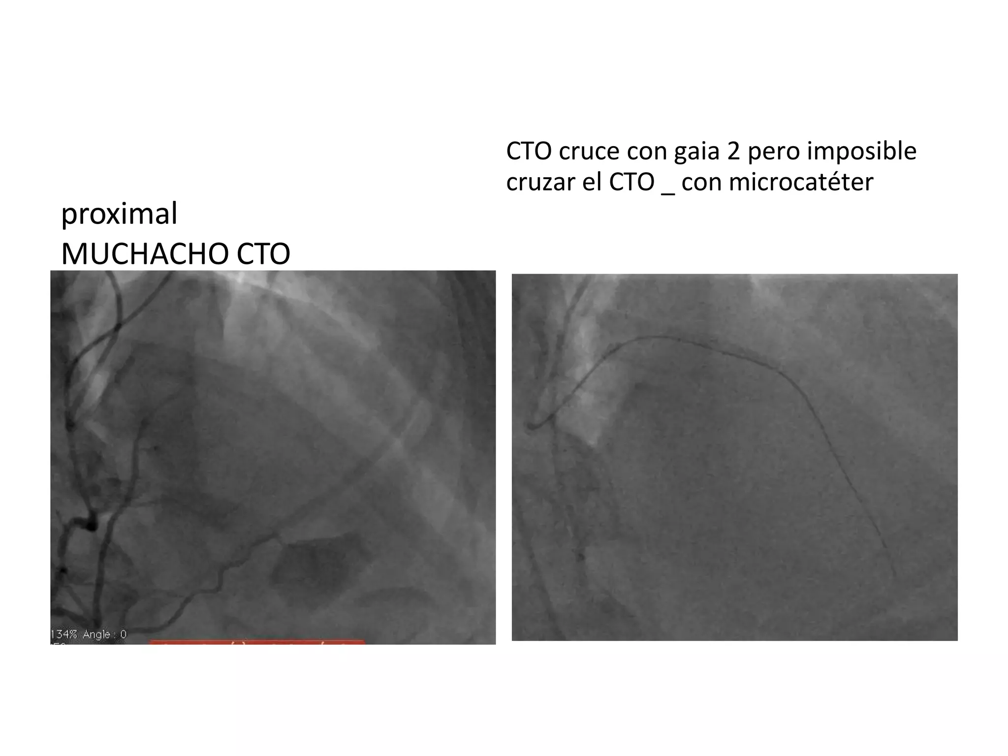 proximal
MUCHACHO CTO
CTO cruce con gaia 2 pero imposible
cruzar el CTO _ con microcatéter
 