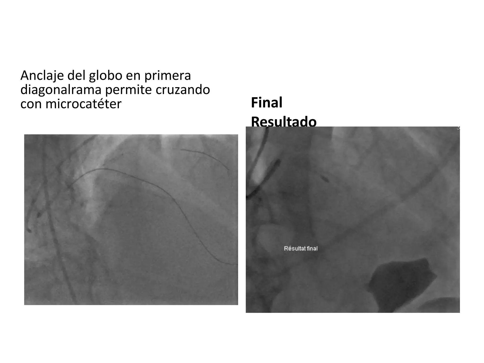Anclaje del globo en primera
diagonalrama permite cruzando
con microcatéter Final
Resultado
 