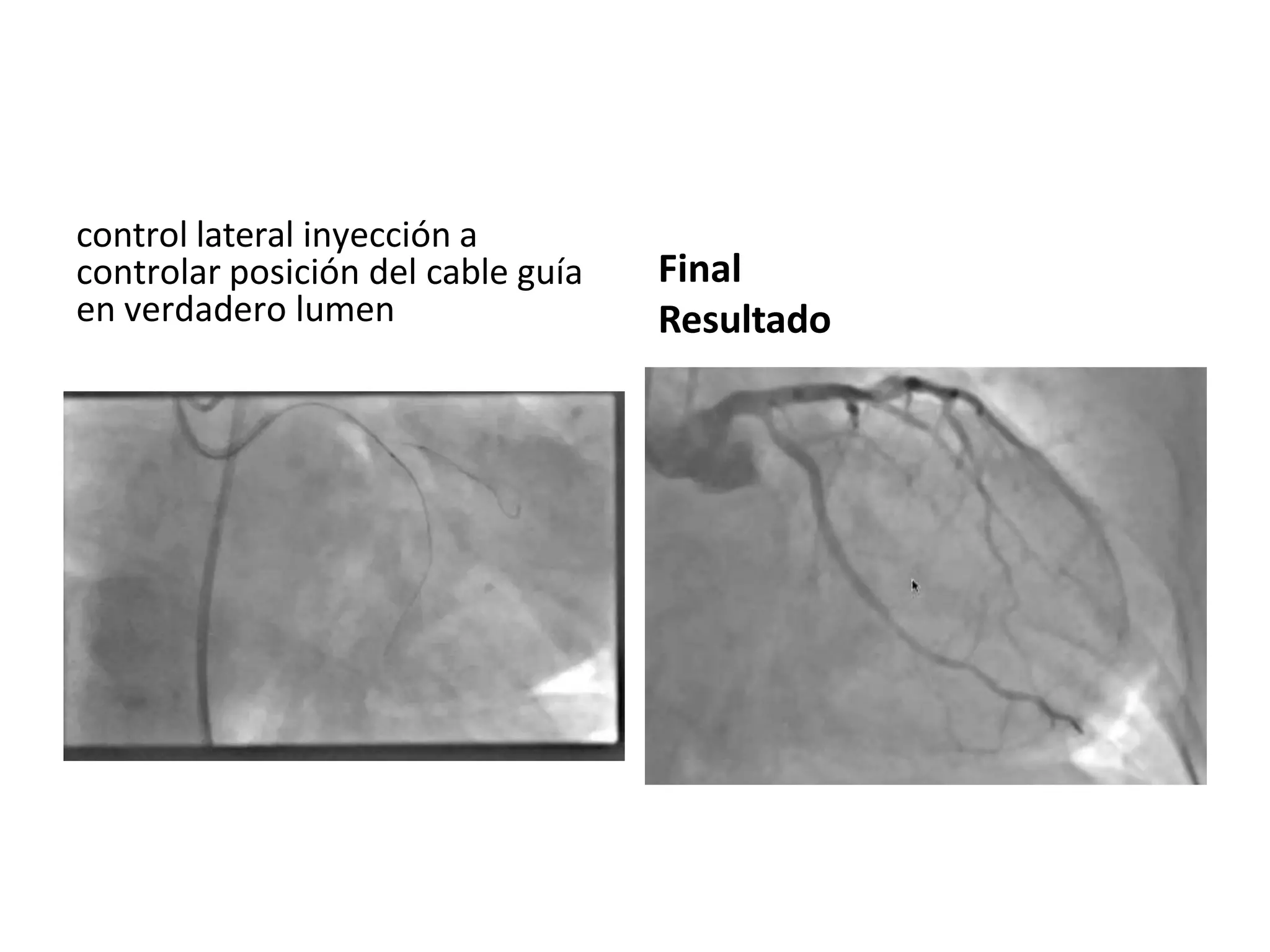 control lateral inyección a
controlar posición del cable guía
en verdadero lumen
Final
Resultado
 