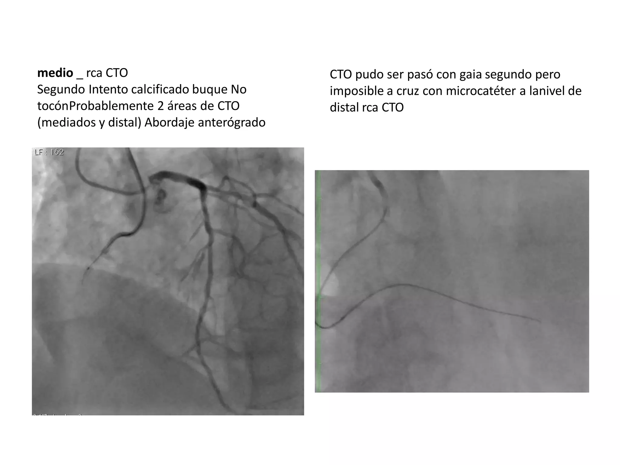 CTO pudo ser pasó con gaia segundo pero
imposible a cruz con microcatéter a lanivel de
distal rca CTO
medio _ rca CTO
Segundo Intento calcificado buque No
tocónProbablemente 2 áreas de CTO
(mediados y distal) Abordaje anterógrado
 