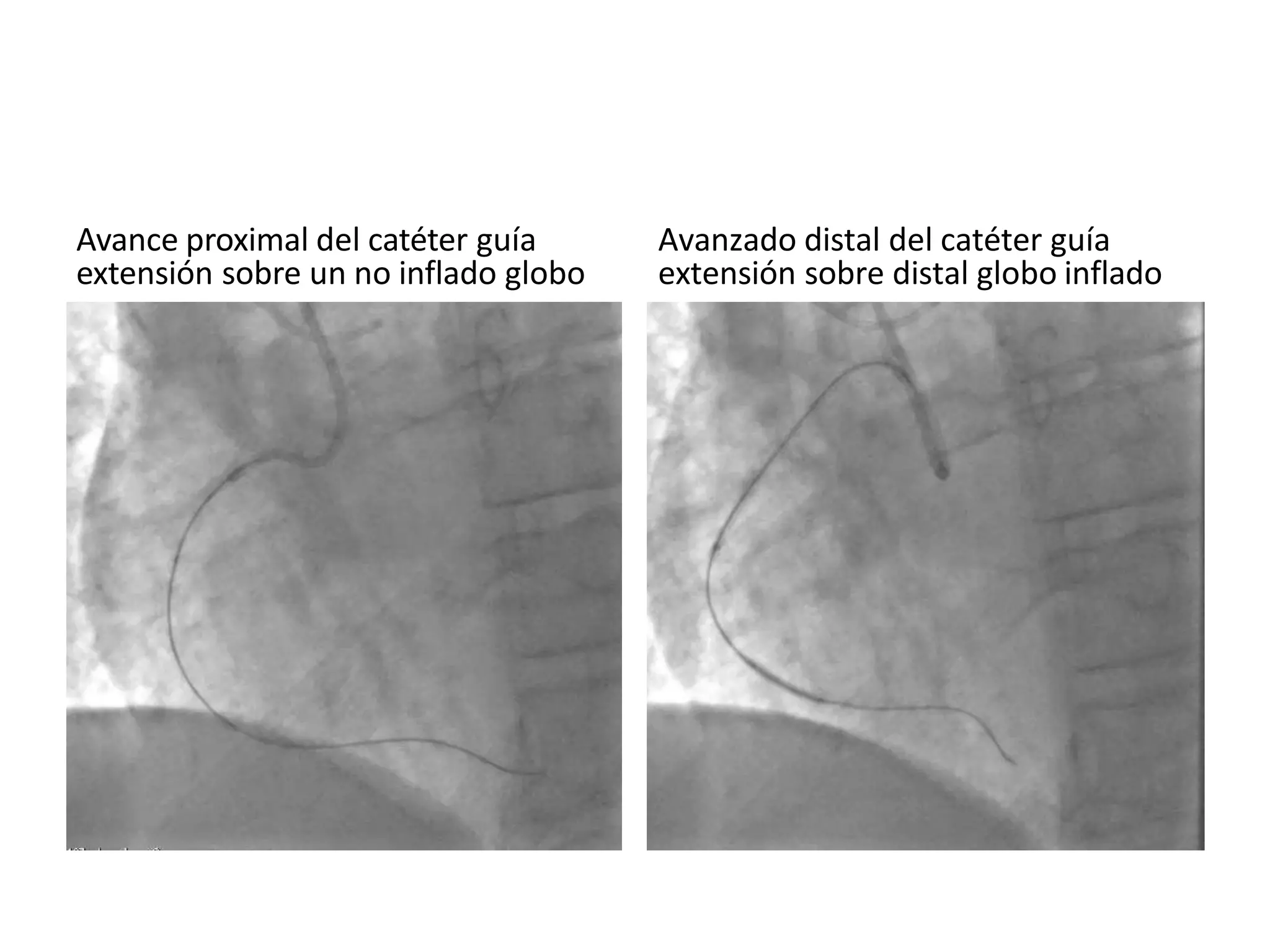 Avance proximal del catéter guía
extensión sobre un no inflado globo
Avanzado distal del catéter guía
extensión sobre distal globo inflado
 