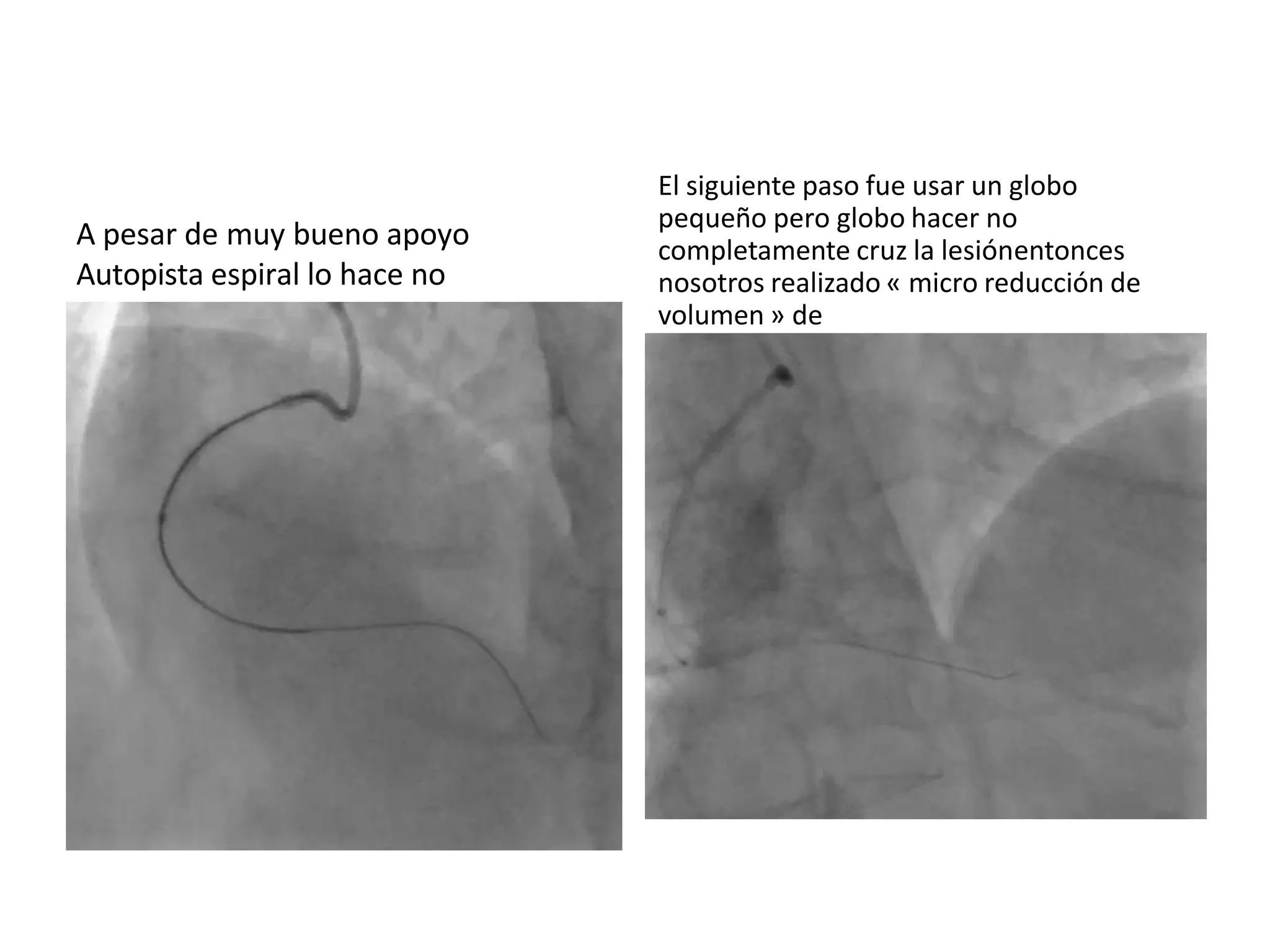 A pesar de muy bueno apoyo
Autopista espiral lo hace no
cruz
El siguiente paso fue usar un globo
pequeño pero globo hacer no
completamente cruz la lesiónentonces
nosotros realizado « micro reducción de
volumen » de
la próximo gorra con a globo de 1,2 mm
inflado a las 16 atm
 