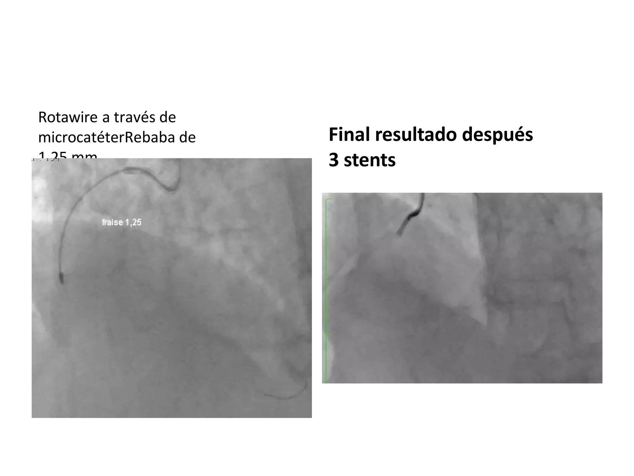 Rotawire a través de
microcatéterRebaba de
1,25 mm
Final resultado después
3 stents
 