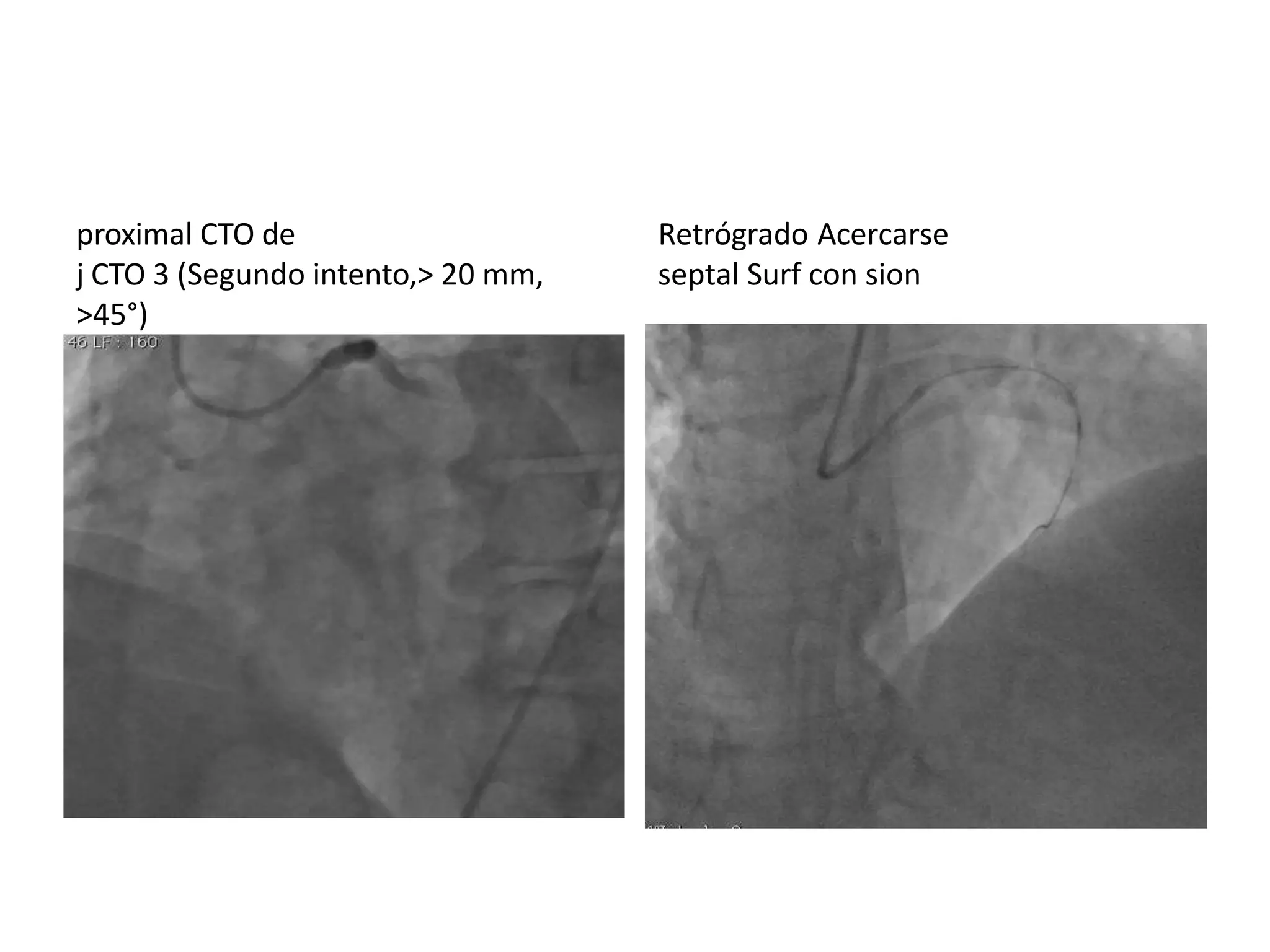 proximal CTO de
j CTO 3 (Segundo intento,> 20 mm,
>45°)
Retrógrado Acercarse
septal Surf con sion
 