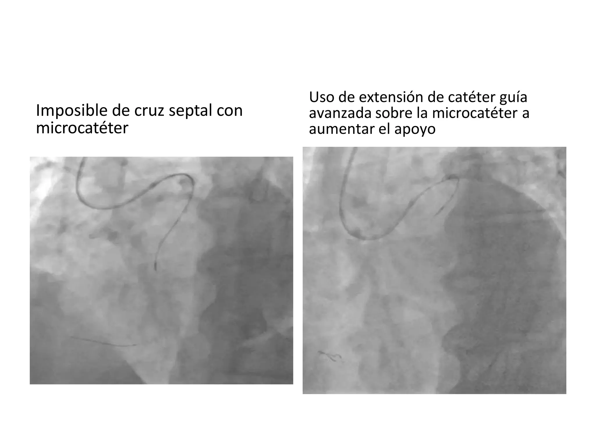 Imposible de cruz septal con
microcatéter
Uso de extensión de catéter guía
avanzada sobre la microcatéter a
aumentar el apoyo
 