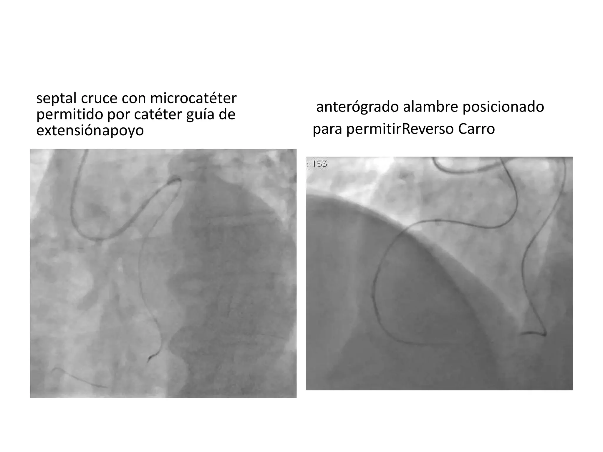 septal cruce con microcatéter
permitido por catéter guía de
extensiónapoyo
anterógrado alambre posicionado
para permitirReverso Carro
 