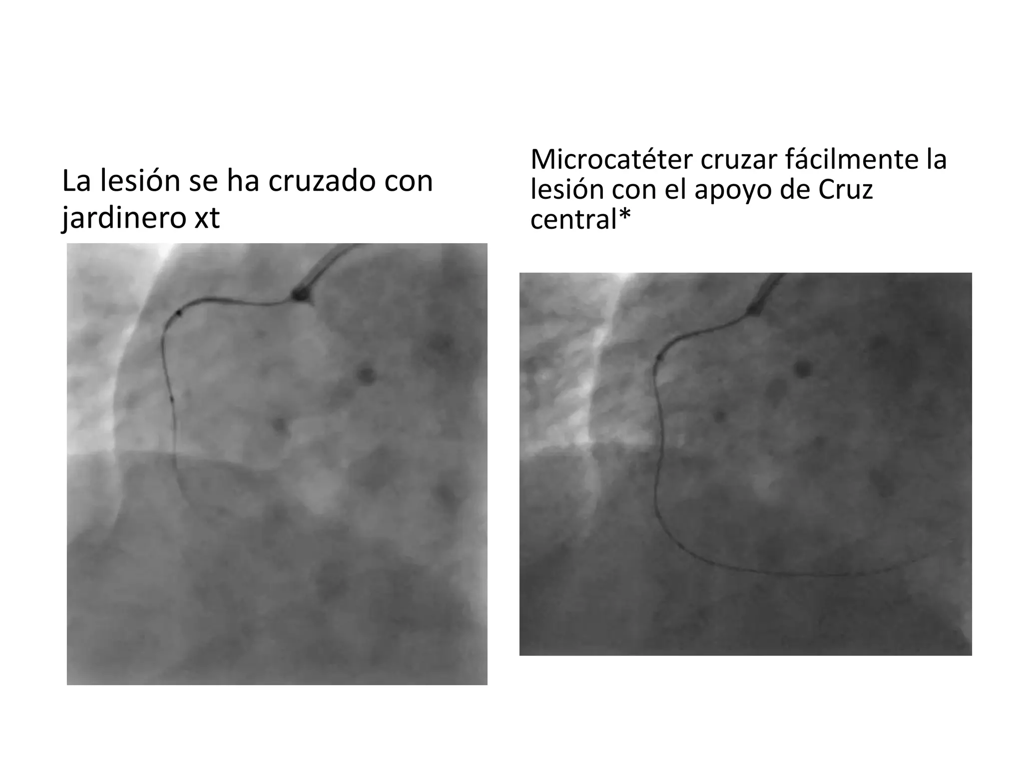 La lesión se ha cruzado con
jardinero xt
Microcatéter cruzar fácilmente la
lesión con el apoyo de Cruz
central*
 