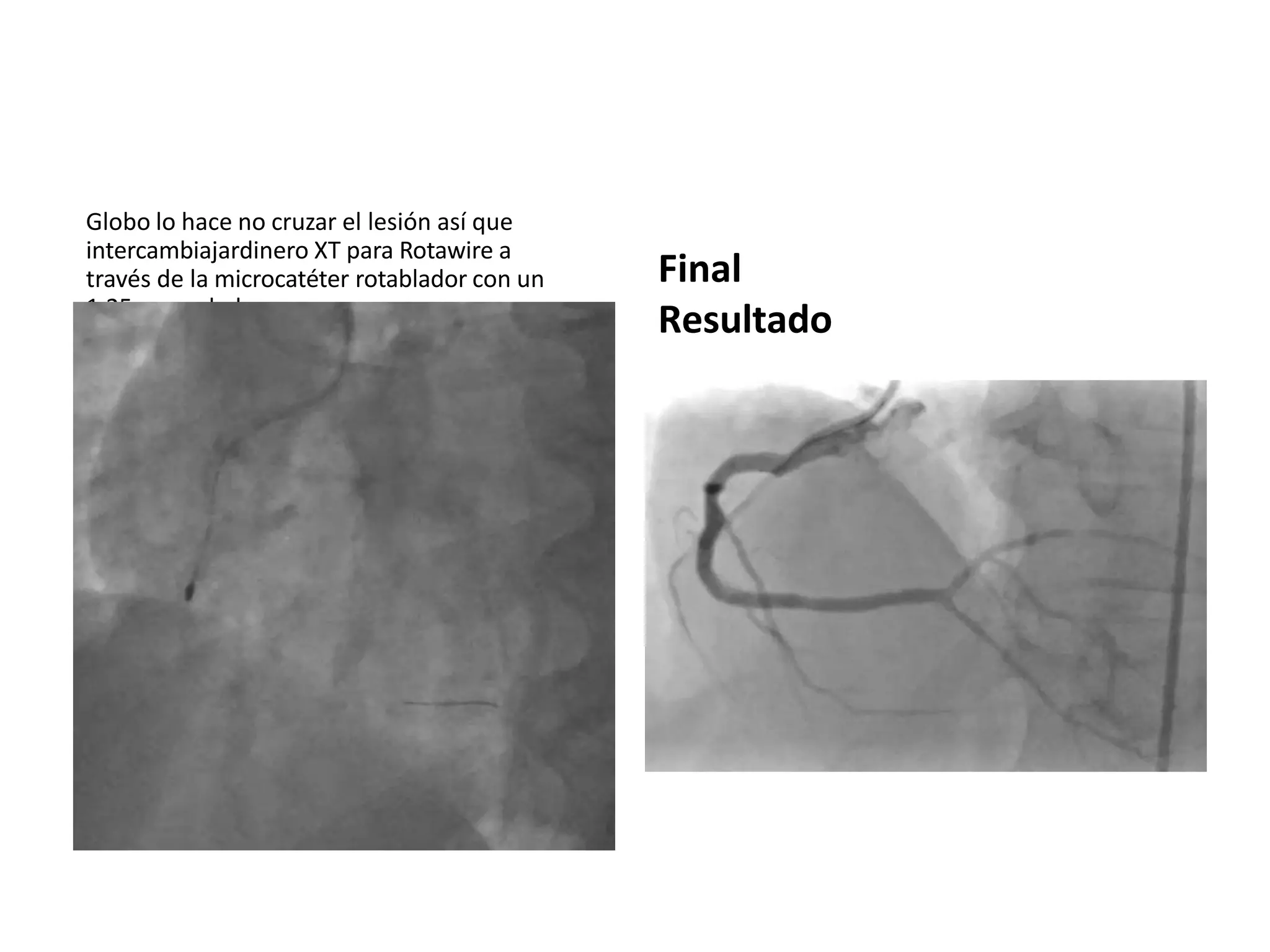 Globo lo hace no cruzar el lesión así que
intercambiajardinero XT para Rotawire a
través de la microcatéter rotablador con un
1,25 mm rebaba
Final
Resultado
 