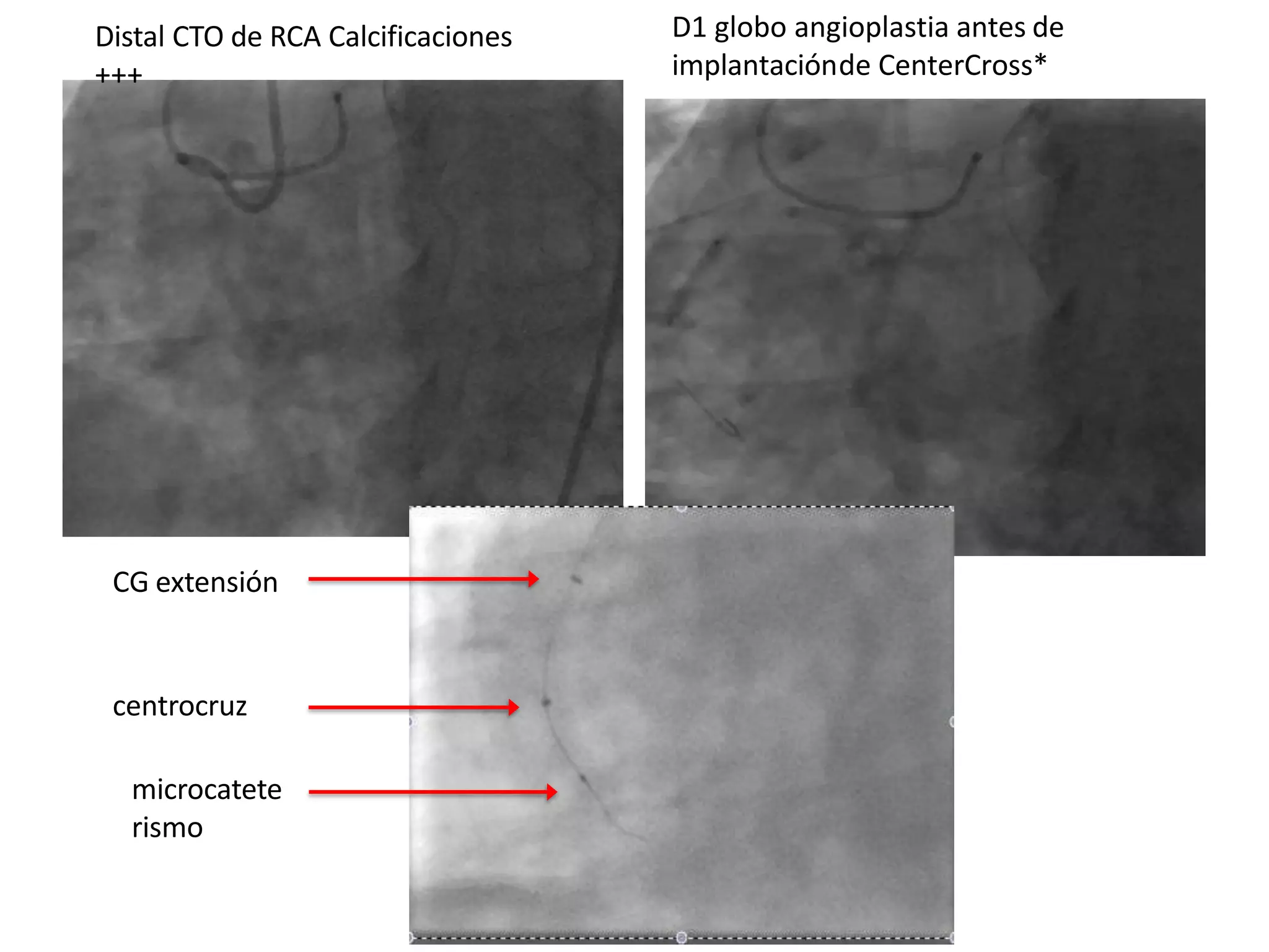 CG extensión
centrocruz
microcatete
rismo
Distal CTO de RCA Calcificaciones
+++
D1 globo angioplastia antes de
implantaciónde CenterCross*
 
