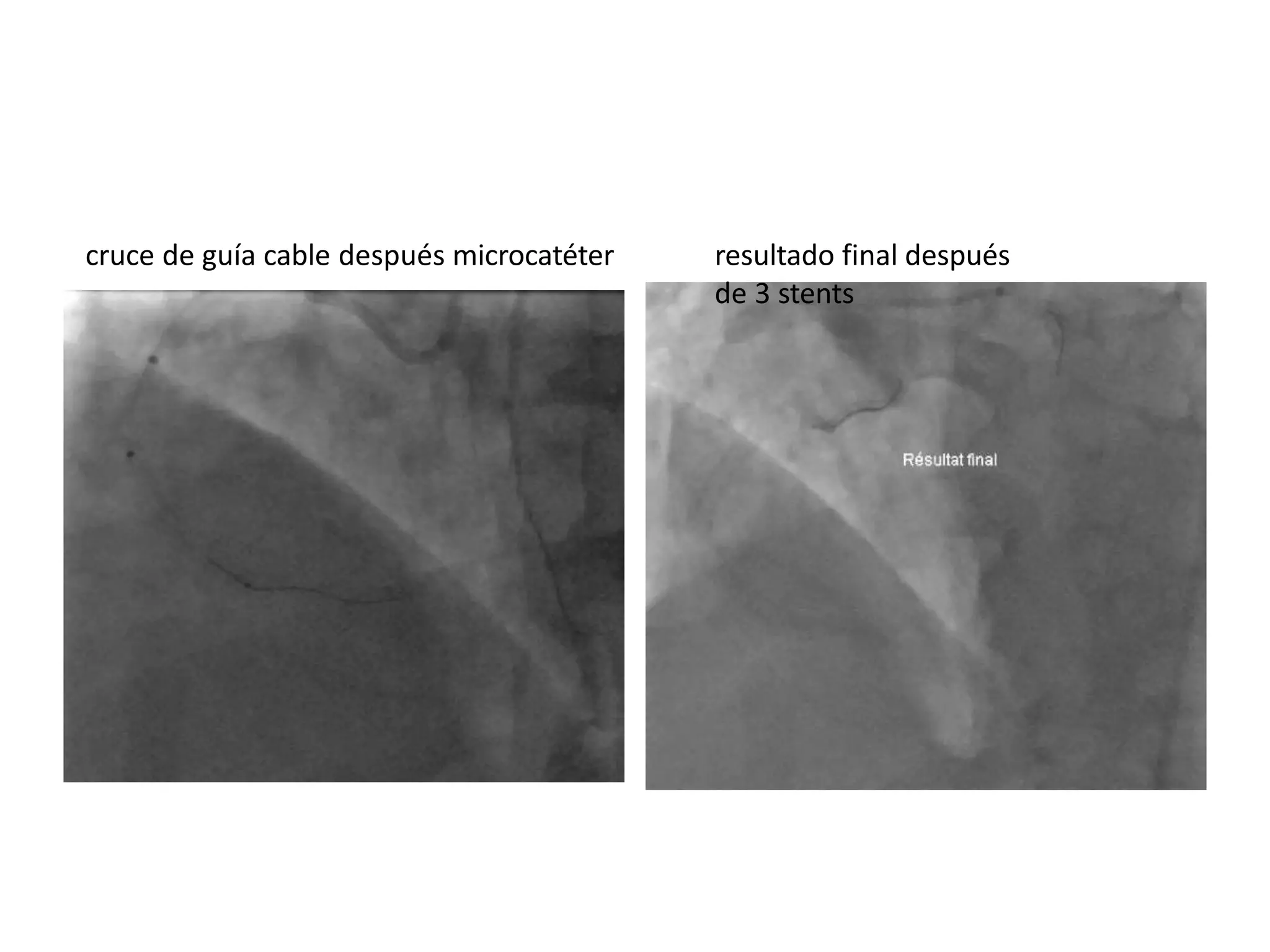 cruce de guía cable después microcatéter resultado final después
de 3 stents
 