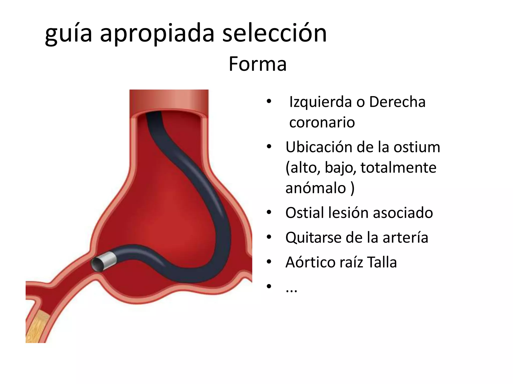 guía apropiada selección
Forma
• Izquierda o Derecha
coronario
• Ubicación de la ostium
(alto, bajo, totalmente
anómalo )
• Ostial lesión asociado
• Quitarse de la artería
• Aórtico raíz Talla
• ...
 