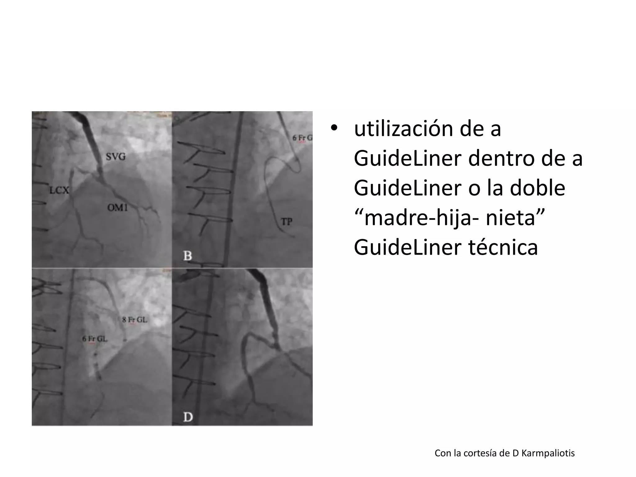 • utilización de a
GuideLiner dentro de a
GuideLiner o la doble
“madre-hija- nieta”
GuideLiner técnica
Con la cortesía de D Karmpaliotis
 