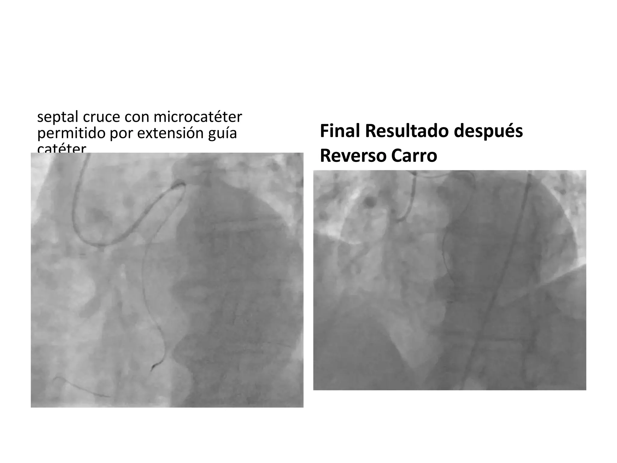 septal cruce con microcatéter
permitido por extensión guía
catéter
Final Resultado después
Reverso Carro
 
