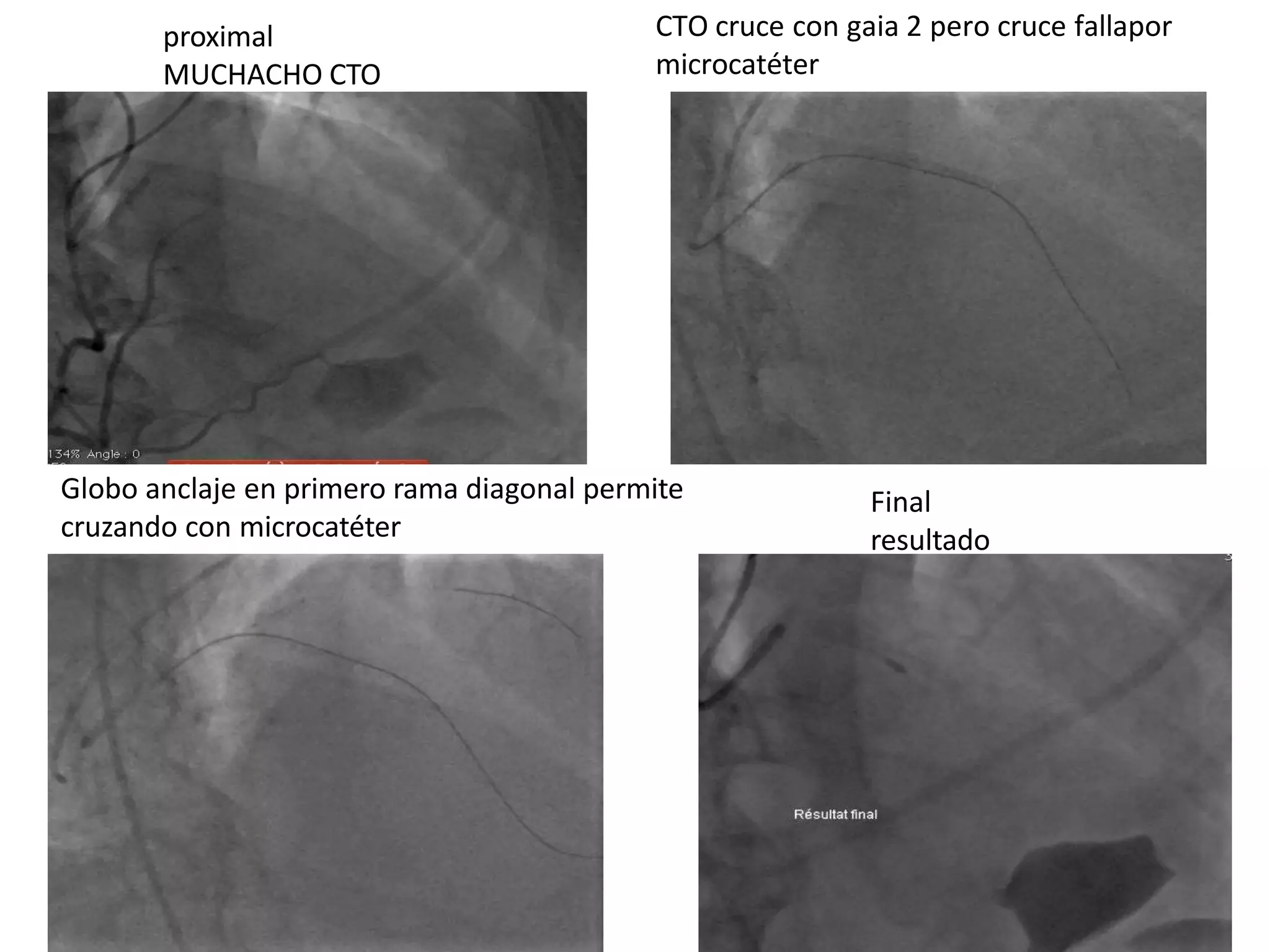 proximal
MUCHACHO CTO
CTO cruce con gaia 2 pero cruce fallapor
microcatéter
Globo anclaje en primero rama diagonal permite
cruzando con microcatéter
Final
resultado
 