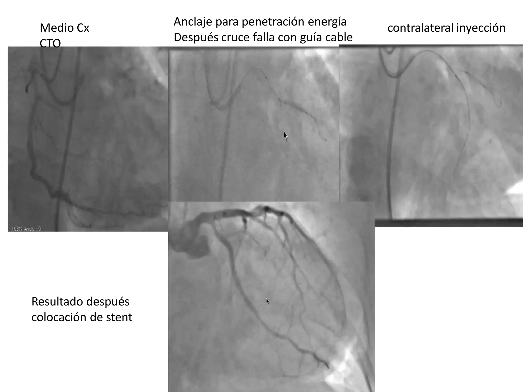 Medio Cx
CTO
Anclaje para penetración energía
Después cruce falla con guía cable
contralateral inyección
Resultado después
colocación de stent
 