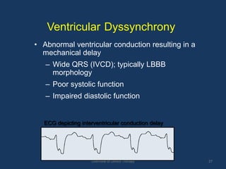 Overview of Device Therapy 27
Ventricular Dyssynchrony
• Abnormal ventricular conduction resulting in a
mechanical delay
– Wide QRS (IVCD); typically LBBB
morphology
– Poor systolic function
– Impaired diastolic function
ECG depicting interventricular conduction delay
 