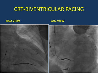 CRT-BIVENTRICULAR PACING
RAO VIEW LAO VIEW
 
