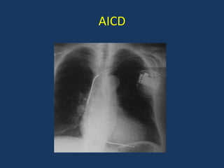 AICD
 