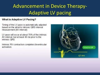 Advancement in Device Therapy-
Adaptive LV pacing
 