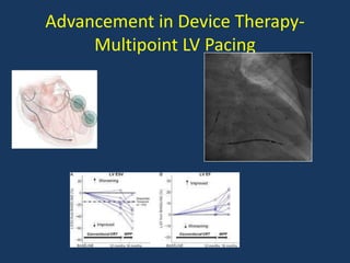 Advancement in Device Therapy-
Multipoint LV Pacing
 
