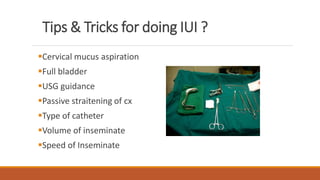 Tips & Tricks for doing IUI ?
Cervical mucus aspiration
Full bladder
USG guidance
Passive straitening of cx
Type of catheter
Volume of inseminate
Speed of Inseminate
 