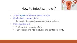 ◦ Slowly inject sample over 30-60 seconds
◦ Finally, inject column of air
◦ To push in the sample remaining in the catheter
◦ If injected too fast
◦ Flushing and retrograde flow
◦ Push the sperms into the tubes and peritoneal cavity
How to inject sample ?
 