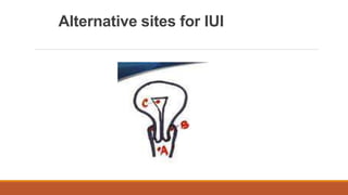 Alternative sites for IUI
 