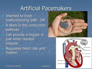 Artificial Pacemakers
 Inserted to treat
malfunctioning SAN OR
 A block in the conduction
pathway.
 Can provide a regular or
just when needed
impusle.
 Regulates heart rate and
rhythm
4/10/2016 2:58 PM cottingham
 