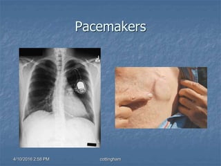 Pacemakers
4/10/2016 2:58 PM cottingham
 