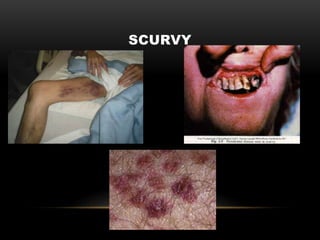 SCURVY
 