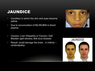 JAUNDICE
• Condition in which the skin and eyes become
yellow
• Due to accumulation of BILIRUBIN in blood
plasma
• Causes: Liver (Hepatitis or Cancer), Gall
Bladder (gall stones), Bile duct disease
• Result: could damage the brain, in infants –
cerebralpalsy
 