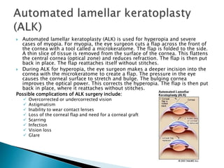  Automated lamellar keratoplasty (ALK) is used for hyperopia and severe
cases of myopia. For myopia, the eye surgeon cuts a flap across the front of
the cornea with a tool called a microkeratome. The flap is folded to the side.
A thin slice of tissue is removed from the surface of the cornea. This flattens
the central cornea (optical zone) and reduces refraction. The flap is then put
back in place. The flap reattaches itself without stitches.
 During ALK for hyperopia, the eye surgeon makes a deeper incision into the
cornea with the microkeratome to create a flap. The pressure in the eye
causes the corneal surface to stretch and bulge. The bulging cornea
improves the optical power. This corrects the hyperopia. The flap is then put
back in place, where it reattaches without stitches.
Possible complications of ALK surgery include:
 Overcorrected or undercorrected vision
 Astigmatism
 Inability to wear contact lenses
 Loss of the corneal flap and need for a corneal graft
 Scarring
 Infection
 Vision loss
 Glare
 