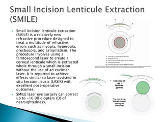  Small incision lenticule extraction
(SMILE) is a relatively new
refractive procedure designed to
treat a multitude of refractive
errors such as myopia, hyperopia,
presbyopia, and astigmatism. The
procedure involves using a
femtosecond laser to create a
corneal lenticule which is extracted
whole through a small incision
without the use of an excimer
laser. It is reported to achieve
effects similar to laser-assisted in
situ keratomileusis (LASIK) with
excellent post-operative
outcomes.
 SMILE laser eye surgery can correct
up to -10.00 diopters (D) of
nearsightedness.
 